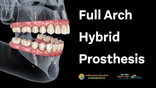 Full Arch Hybrid Prosthesis  Ask Dr Ting [upl. by Aillicsirp]