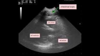 Peritoneopericardial Diaphragmatic Hernia PPDH [upl. by Eyahc199]