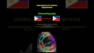 Echocardiography  Inferolateral At Inferior Hypokinesia [upl. by Cherlyn]