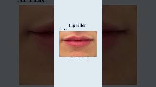 Lip Filler Injections  Before and After Lip Augmentation [upl. by Carmelo244]