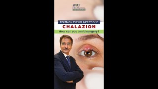 आँख की पलक में गाँठ Chalazion का कारण और उपचार  Dr Deepak Vaidya  Eye Surgeon [upl. by Dame]