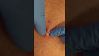 Sebaceous cyst extraction by a dermatologist shorts pimplepopping  CONTOUR DERMATOLOGY [upl. by Cerracchio]