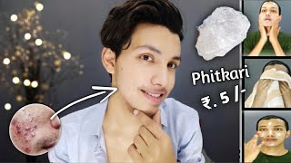 सिर्फ 3 दिन Use कर लो Acne Pimple Tiny Bumps खत्म  Phitkari  How To Use  100 Guranteed Results [upl. by Llednav]