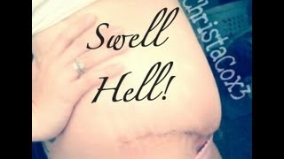 Tummy Tuck SWELL HELL Fluid verses Fat Swelling 6 weeks PostOp [upl. by Hafirahs]