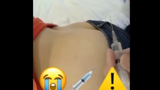 intramuscular buttock injection [upl. by Lienhard62]