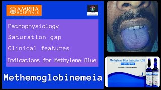 Methemoglobinemeia  Saturation gap  Methylene blue [upl. by Lirba]