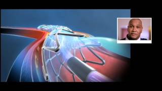 What is a stent and how does it work [upl. by Sklar]