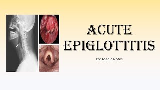 Acute epiglottitis  EMERGENCY condition causes clinical features investigation treatment [upl. by Oralla]