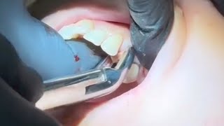 Extraction for First Maxillary Premolar [upl. by Aitel]