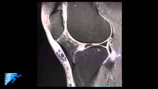 How to Read Knee MRI of Meniscal Root Tear  Knee Surgery Recovery Time  Minneapolis St Paul MN [upl. by Samira40]