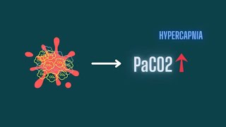 Hypercapnia Pathophysiology Of CO2 Retention [upl. by Jeanna392]