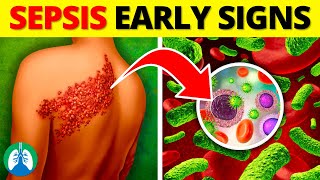 Top 10 Early Warning Signs of Sepsis  NEVER Ignore THIS [upl. by Fanny649]