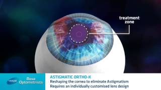 Astigmatism and Orthokeratology  Can Orthokeratology correct Astigmatism  Rose Optometrists [upl. by Abas222]