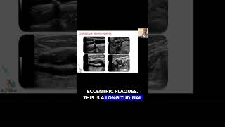 Carotid Plaque Geometry foryou science education vascularultrasound [upl. by Garv]