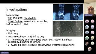 Strategies for Surgical Treatment of Neglected Spondylodiscitis Hazem Elsebaie FRCS MD [upl. by Ssalguod157]