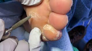 June clinic toenails calluses and corns continue [upl. by Femi892]