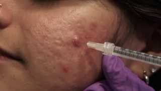 Watch amp Learn Intralesional injections [upl. by Adnav]