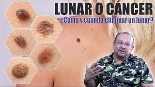 LUNARES Cuando y cómo retirarlos 🚫 Cuidado con los MELANOMAS Cáncer ❤️ DR ALBERTO CALVO QUIROZ [upl. by Lekkim]