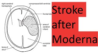 Stroke and death after Moderna [upl. by Atnoed807]