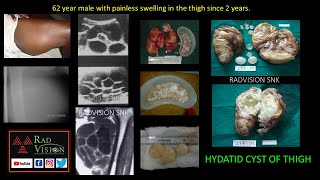 Hydatid cysts Imaging and complications [upl. by Kleper]