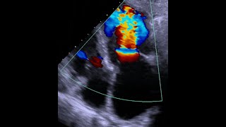 Mitral stenosis Overview and common causes [upl. by Shannah]