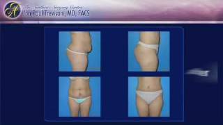 Tummy Tuck Abdominoplasty Surgery Orlando Florida Jon Paul Trevisani MD [upl. by Jeannine]