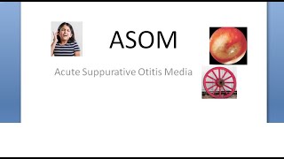 ENT ASOM Acute Suppurative Otitis Media Necrotizing Cart wheel appearance middle ear infection [upl. by Nordine]