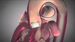 Transcaval TAVR Performed at Oklahoma Heart Institute [upl. by Mokas647]