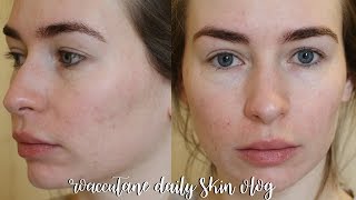 ROACCUTANE DAILY SKIN VLOG  MONTH 7 [upl. by Tad]