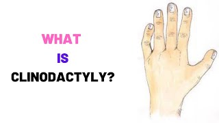 WHAT IS CLINODACTYLY Clinodactyly Causes Symptoms Treatment Surgery [upl. by Sarette]