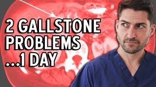 A Day in life of Surgeon Gallstone Ileus amp Pancreatitis [upl. by Beyer510]