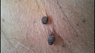 How to Remove Skin Tags and Warts Overnight  Dr Berg Explains [upl. by Frants]