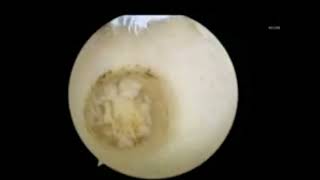 All Arthroscopic Osteochondral Autograft Transplantation for Medial Talar Dome Lesions Talus [upl. by Airrehs]