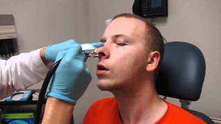 Septoplasty Nasal Splint Packing removal and nose cleaning [upl. by Ahtabat]