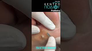 Hard Skin Removal κεντροποδιου kentropodiou podiatry podiatria podologia podology podiatrist [upl. by Kinsley280]