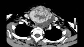 CAT Scan of a Very Large Goiter in the Left Thyroid [upl. by Harned955]