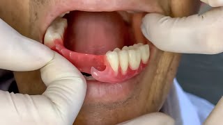 Why flexible dental prosthesis is the best option for you 4K [upl. by Uella]