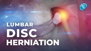 What is Lumbar Disc Herniation  Herniated Disc [upl. by Heeley]