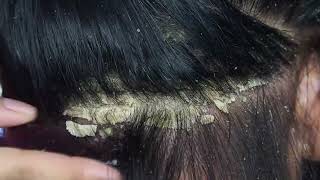 Dandruff scratching removal on head using black combing405 [upl. by Ronoel]