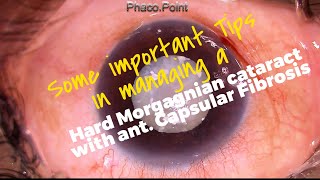 Some Important Tips in managing a Hard Leathery Morgagnian Cataract with a Fibrotic Anterior Capsule [upl. by Godfree]