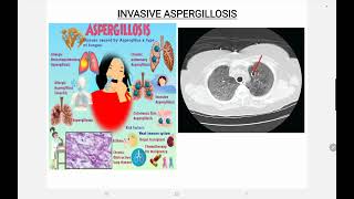 Invasive Aspergillosis [upl. by Aisylla979]