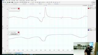 Spirometry demonstration [upl. by Philan3]