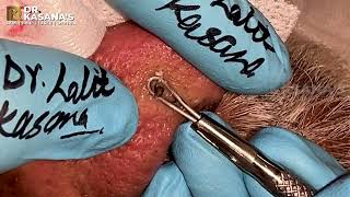 70 YEAR OLD NOSE BLACKHEADS REMOVAL AT DRKASANAS CLINIC [upl. by Ynatsyd]