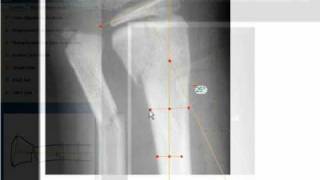 TraumaCad  Metaphyseal Fracture Angulation [upl. by Tien]