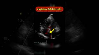 Amplatzer Septal occluder as seen on Echocardiogram echocardiography heart asd [upl. by Luhar728]