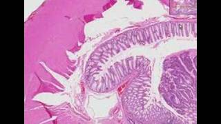 Histopathology Colon Adenocarcinoma [upl. by Gibb185]