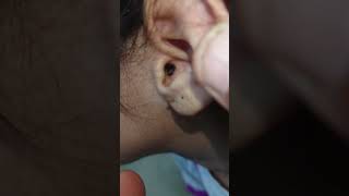 otitis externa with ear wax [upl. by Niltag]