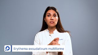 Erythema exsudativum multiforme  Ausschlag nach einem Virus  dermanostic Hautlexikon [upl. by Ettelrac]