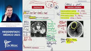 Neurología  6 ABSCESO CEREBRAL [upl. by Yvonner]