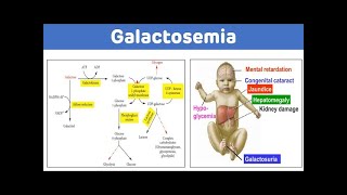 Galactosemia types [upl. by Lydnek]